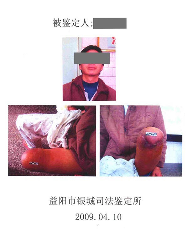 長沙上下肢假肢銷售,截癱支器哪里好,德誠精博義肢矯形康復器材有限公司